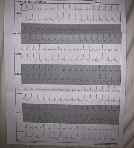 Ekg Normal Medizin Herzrasen Ekg Befund