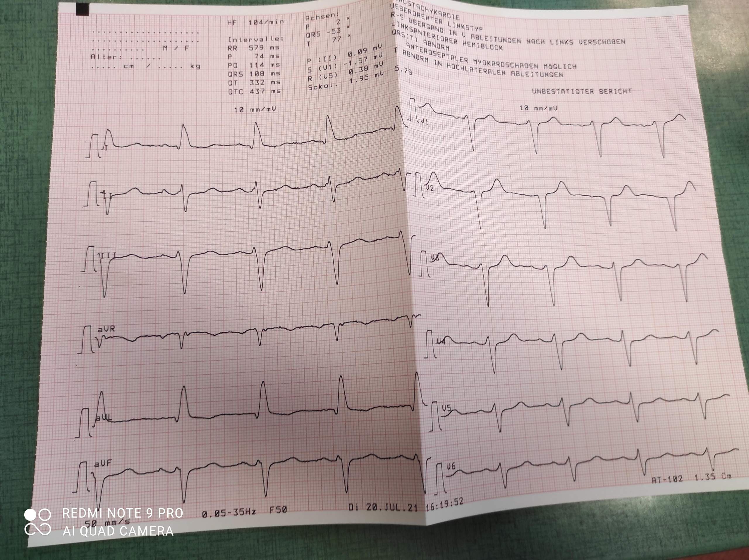 Ekg schlecht? (Gesundheit und Medizin, Herz)