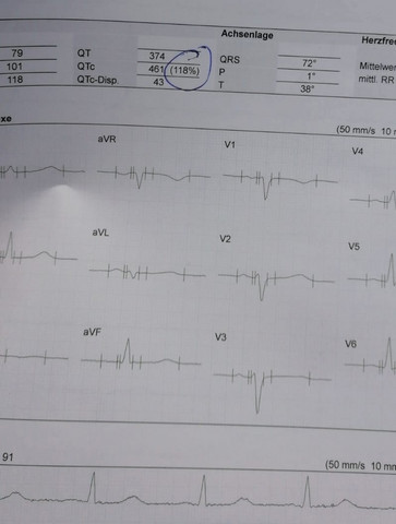 Ekg Weis Jemand Was Das Fur Werte Sind Und Ob Diese Fur W 18 Normal Oder Zu Hoch Sind Medizin