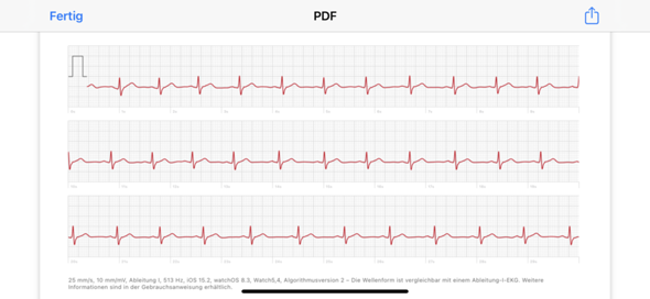 EKG ‚S‘-Welle (qRS) - wieso so tief? (Gesundheit und Medizin, Herz)