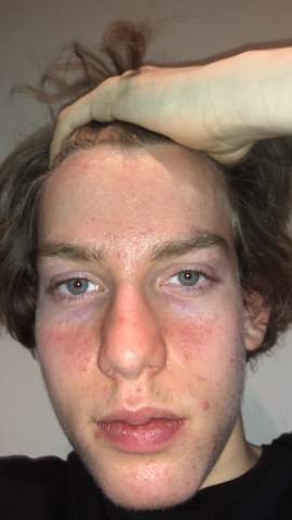 Ekzeme Neben Nase Haut Pickel Ekzeme Neben Nase Haut Pickel