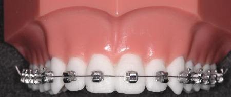 - (Zahnspange, Brackets)
