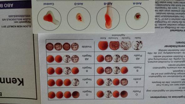 Eldon Blutgruppe Bestimmen Ergebnis Medizin Biologie Blut Eldon Blutgruppe Bestimmen Ergebnis Medizin Biologie Blut