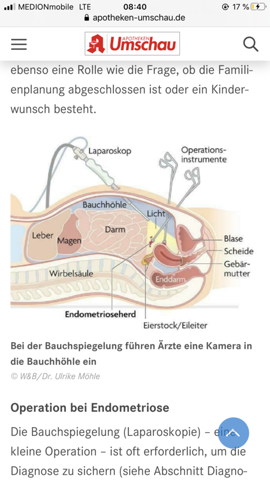 Krank lange zyste op wie eierstock Operation einer