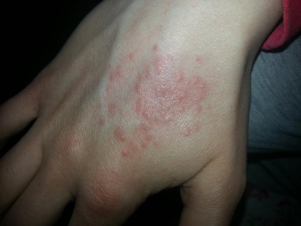 Entsetzlich Juckender Ausschlag An Der Hand Entsetzlich Juckender Ausschlag An Der Hand