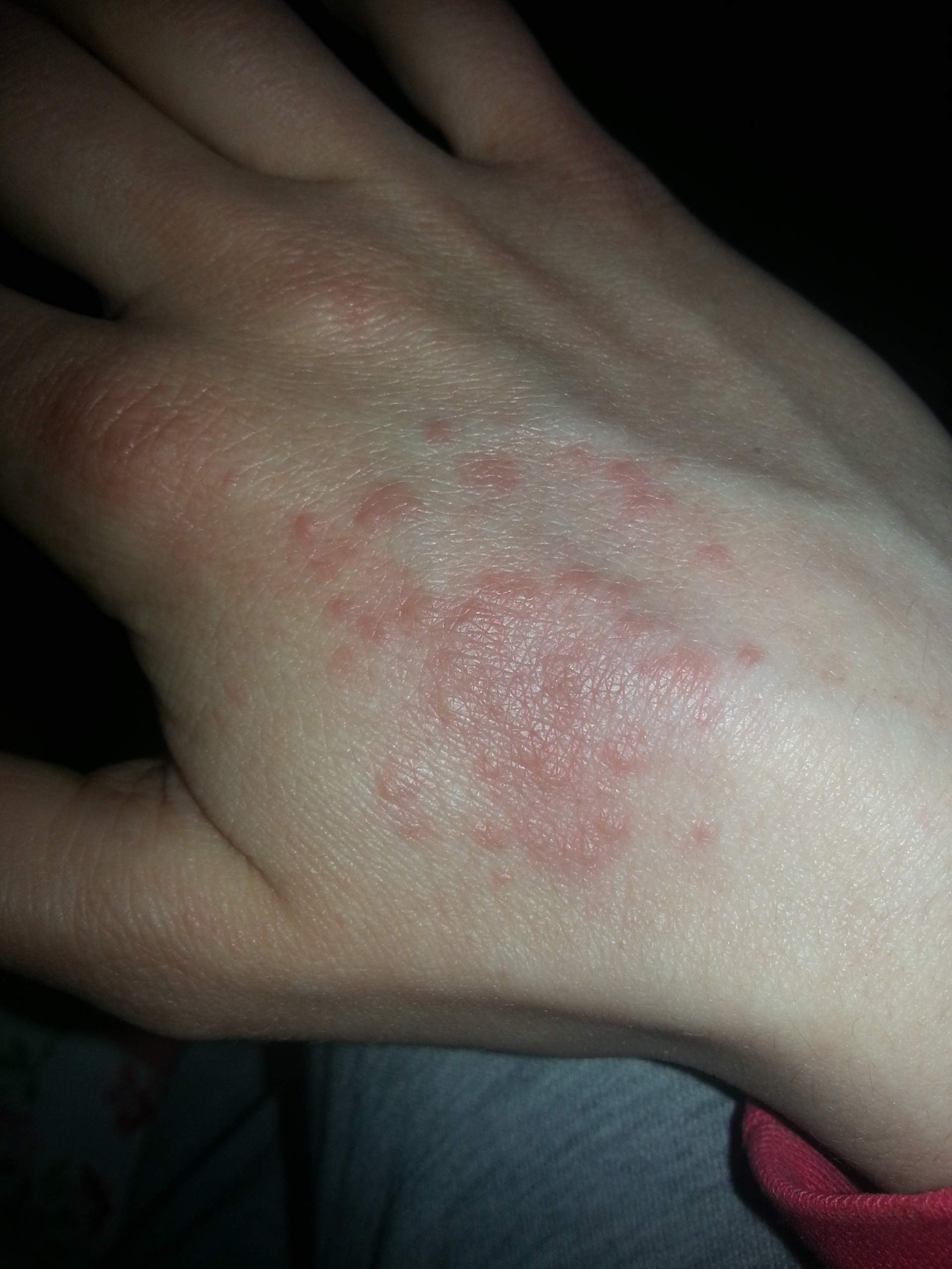 Entsetzlich juckender Ausschlag an der Hand Entsetzlich juckender Ausschlag an der Hand
