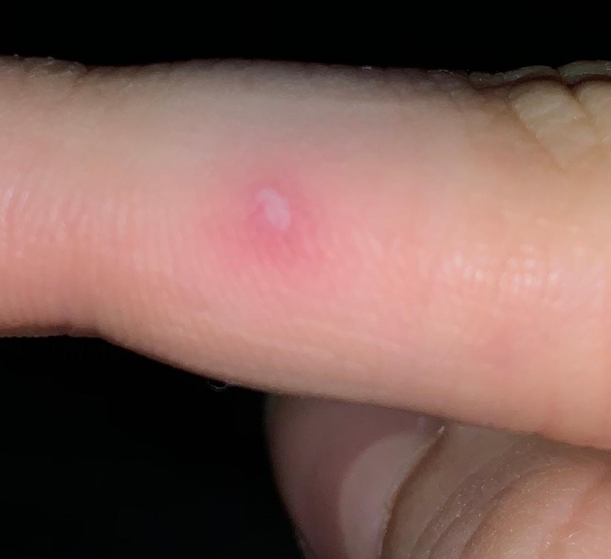 40++ Warze bei kindern bilder , Entsteht an meinem Finger eine Warze? (Gesundheit und Medizin, Haut