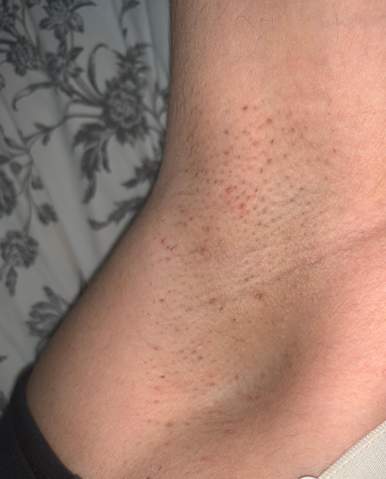 entzundet nach rasieren wachsen zupfen