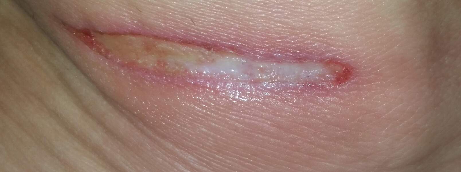 Entzündete Wunde dermolex Entzündete Wunde dermolex