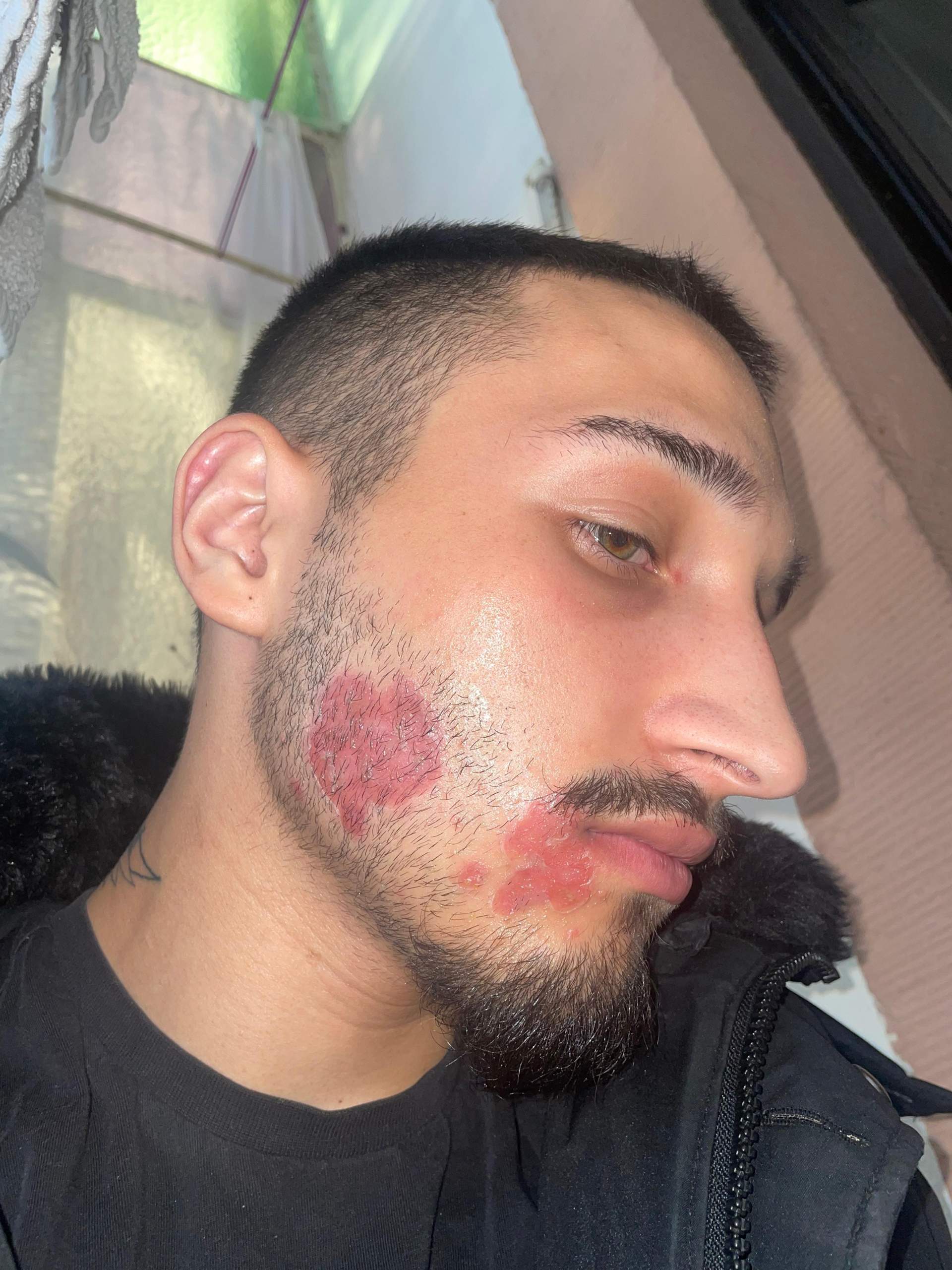 Entzündet oder herpes im gesicht? (Gesundheit und Medizin)