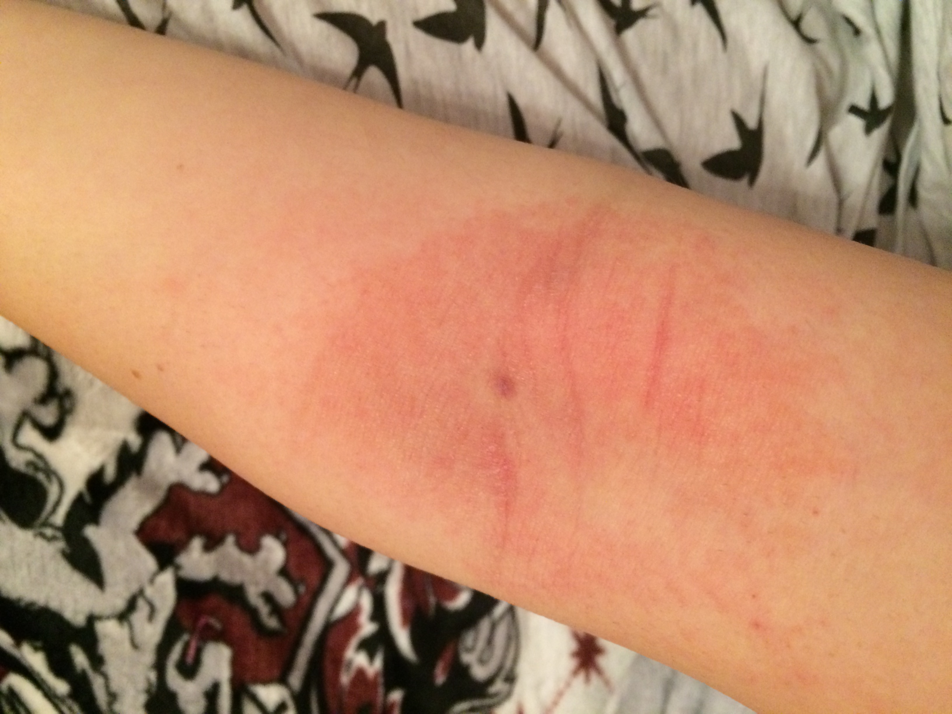 Entzundete Einstichstelle Am Arm Nach Blutspende Entzundung Narben Wundheilung Entzundete Einstichstelle Am Arm Nach Blutspende Entzundung Narben Wundheilung