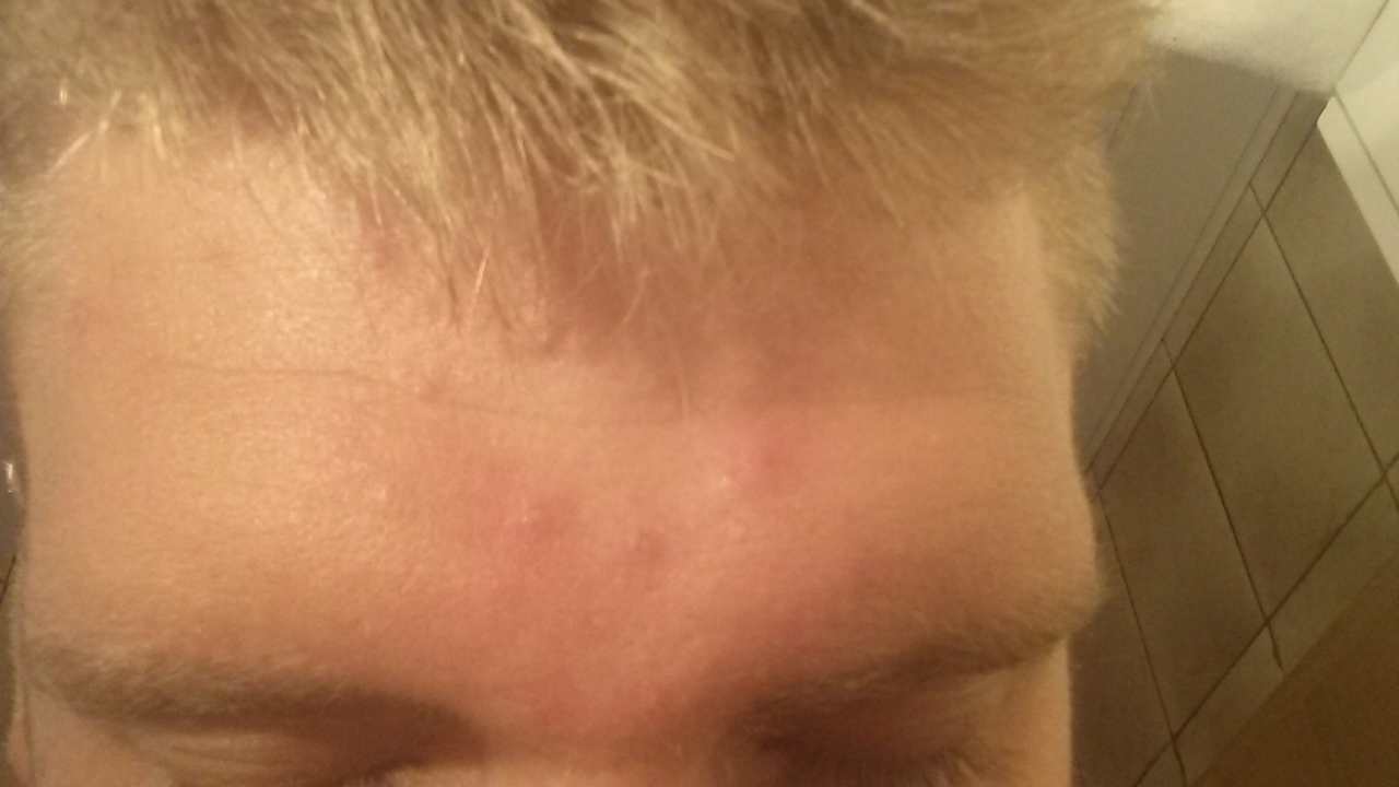 entzündete mitesser? pickel? stirn. (Gesundheit, Beauty, Haut) pickel an der stirn ursache