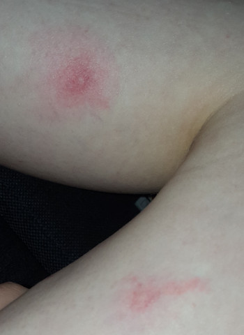 Entzundete Muckenstiche Soll Ich Zum Arzt Gesundheit Und Medizin Allergische Reaktion Entzundete Muckenstiche Soll Ich Zum Arzt Gesundheit Und Medizin Allergische Reaktion