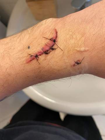Entzundete Narbe Am Handgelenk Nach Schnittwunde Gesundheit Und Medizin Medizin Narben Entzundete Narbe Am Handgelenk Nach Schnittwunde Gesundheit Und Medizin Medizin Narben
