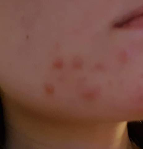 Entzündete Pickel immer an derselben Stelle (Kinn)? (Haut) pickel am kinn und hals
