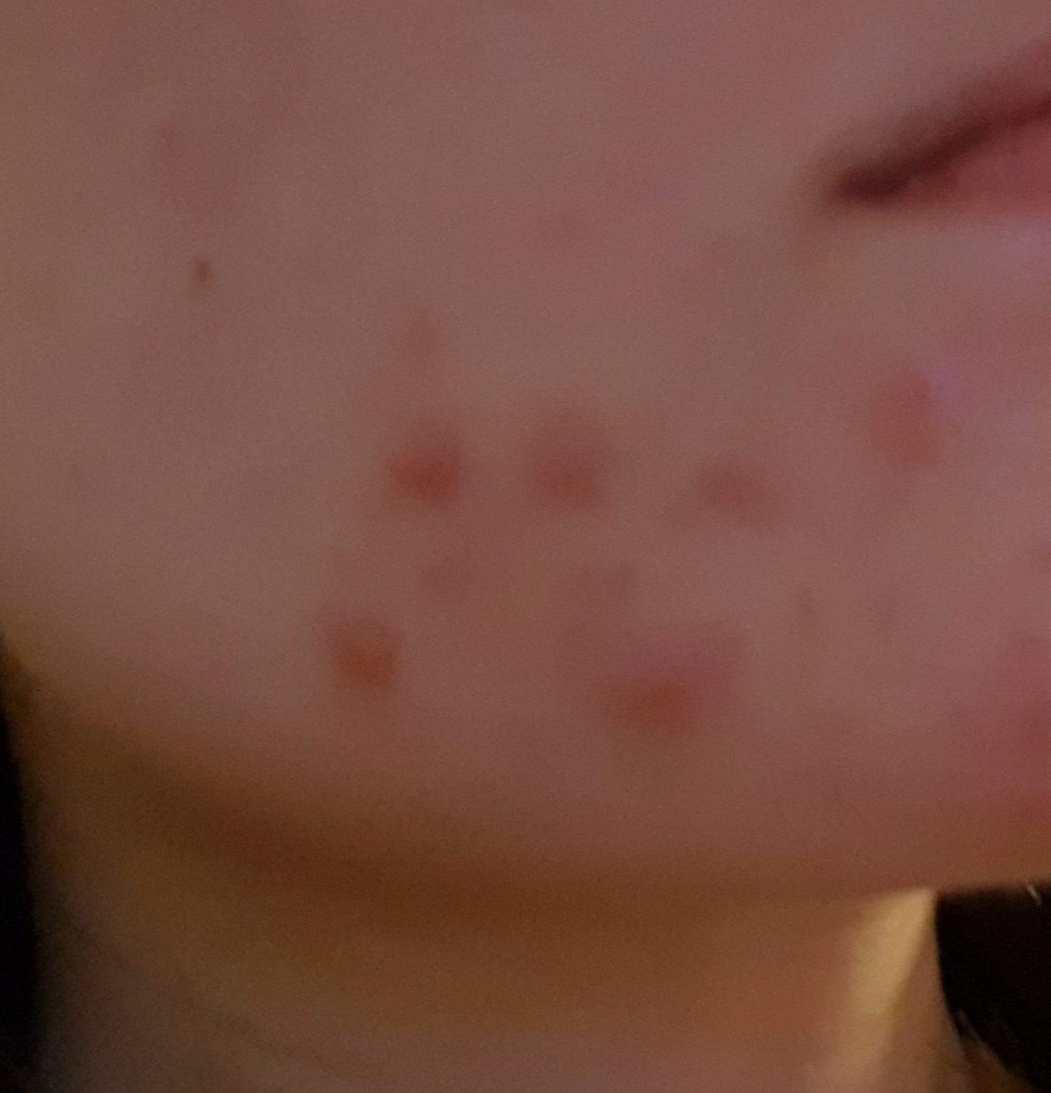 Warum Kommen Pickel Immer An Dergleichen Stelle Entzündete Pickel immer an derselben Stelle (Kinn)? (Haut)