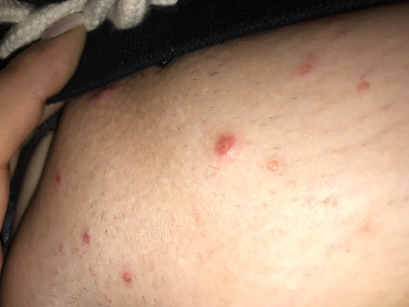 Entzundete Pickel Nach Intimrasur Entzundete Pickel Nach Intimrasur