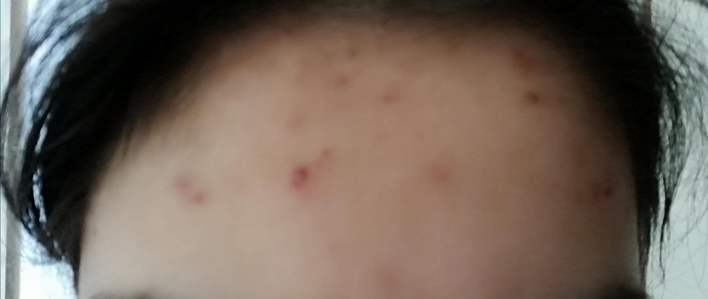 Entzundete Pickel Wegkriegen Pubertat Hautpflege Akne Entzundete Pickel Wegkriegen Pubertat Hautpflege Akne