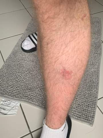 Entzündeter mückenstich (kriebelmücke) Rötung großflächig? (Gesundheit und Medizin, Gesundheit ...