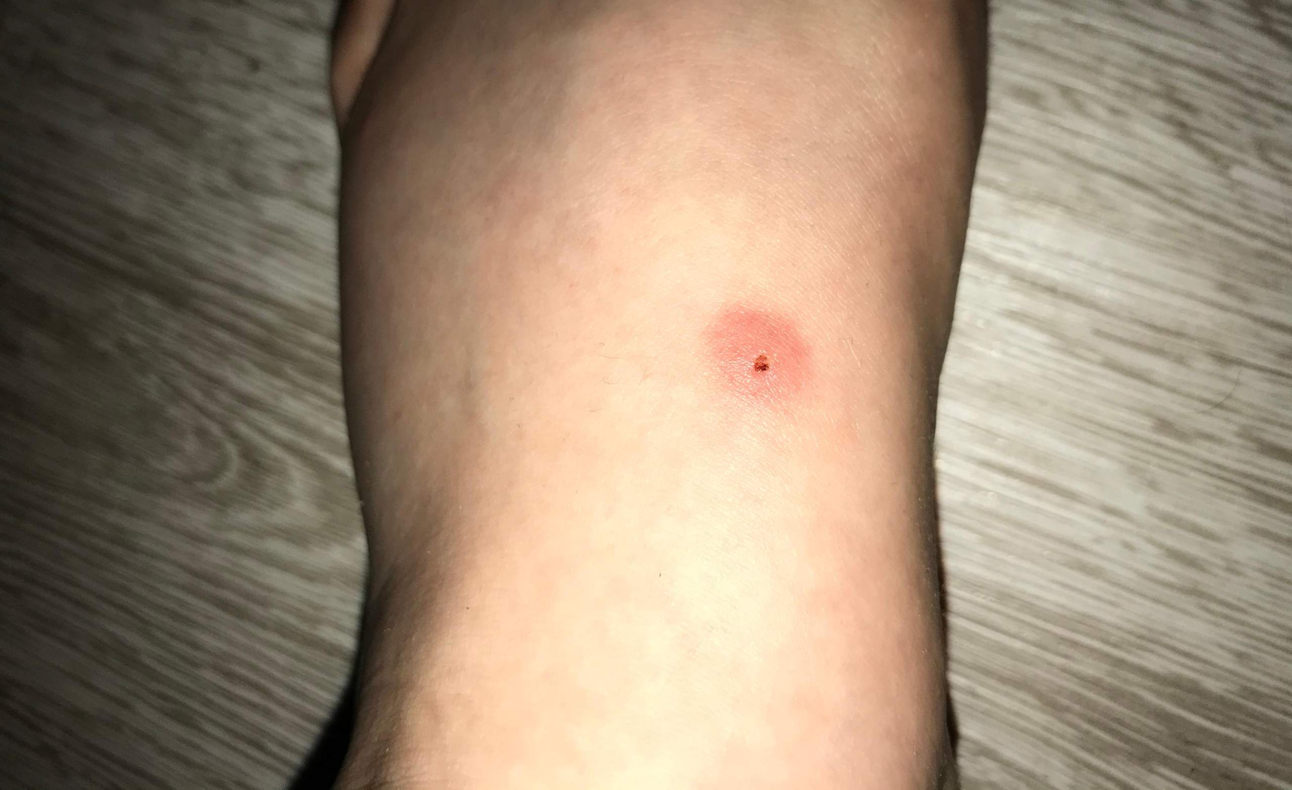 Entzündeter mückenstich oder zeckenbiss? (Gesundheit und Medizin)