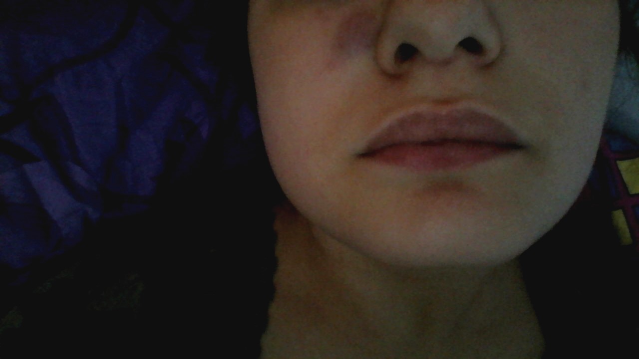 Entzündeter Pickel neben der Nase (Entzündung)