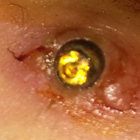 Piercing entzündet was tun Piercing entzündet was tun