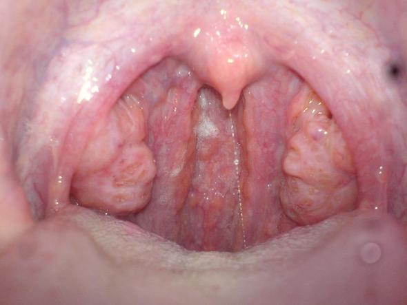 Entzündeter Rachen. Was ist das? (Arzt, Krankheit, Eiter) Entzündeter Rachen. Was ist das? (Arzt, Krankheit, Eiter)