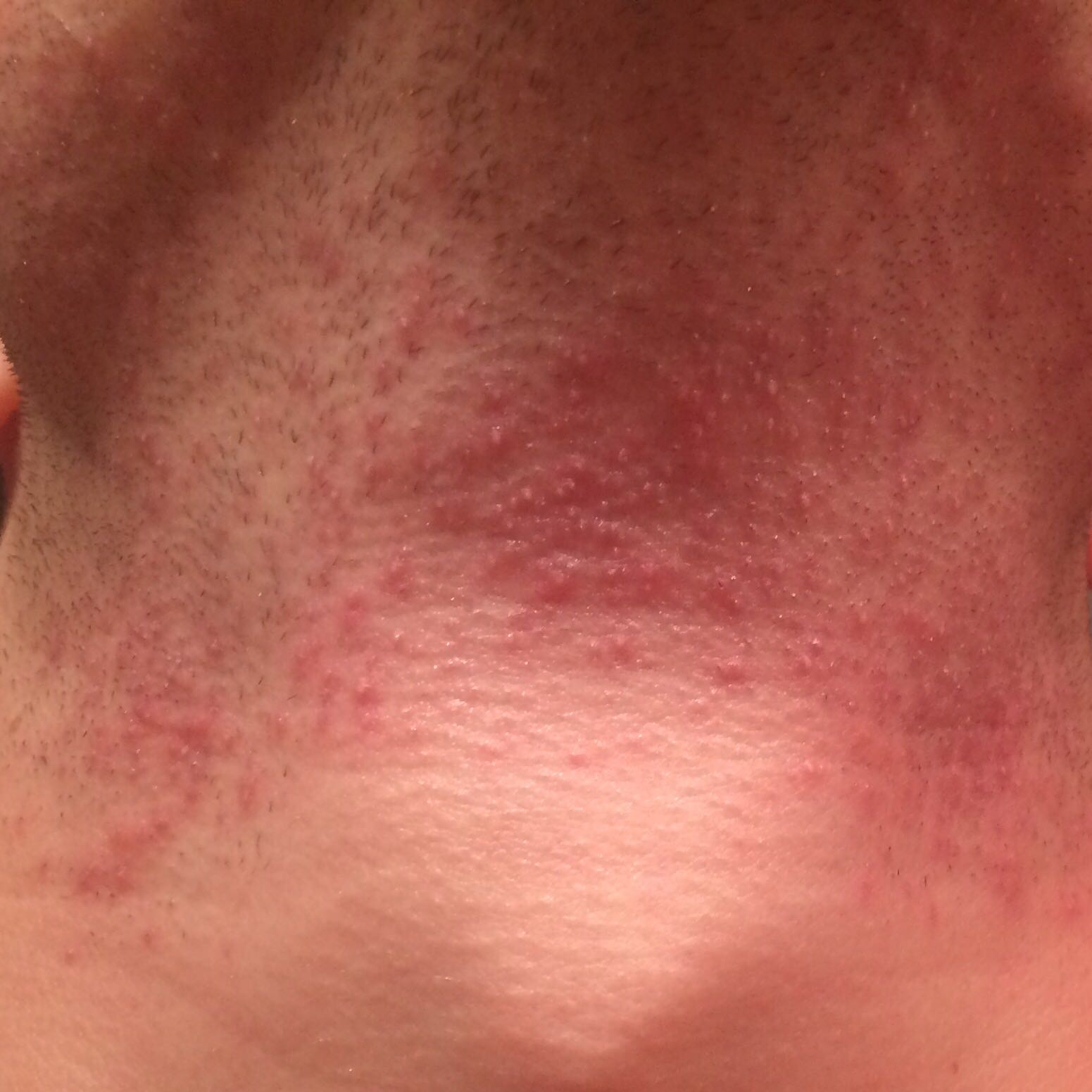 entzündeter rasurbrand!? (Rasur)