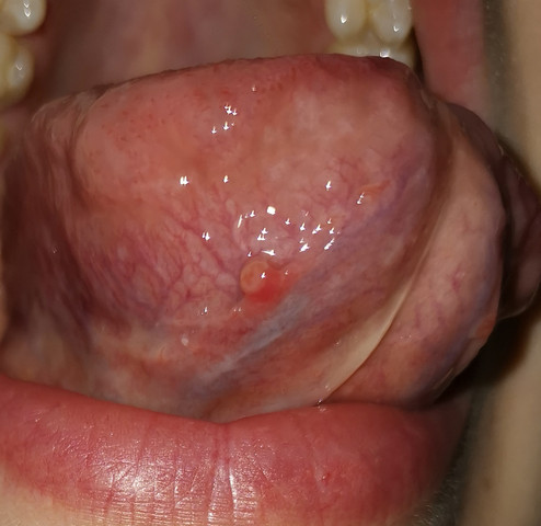 Entzundeter Zipfel Aphte Unter Der Zunge Aphten Im Mund Speicheldruse Entzundeter Zipfel Aphte Unter Der Zunge Aphten Im Mund Speicheldruse