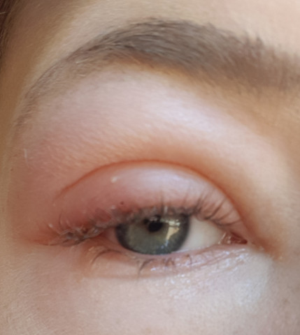Entzundetes Und Geschwollenes Auge Gesundheit Und Medizin Augen Entzundung Entzundetes Und Geschwollenes Auge Gesundheit Und Medizin Augen Entzundung