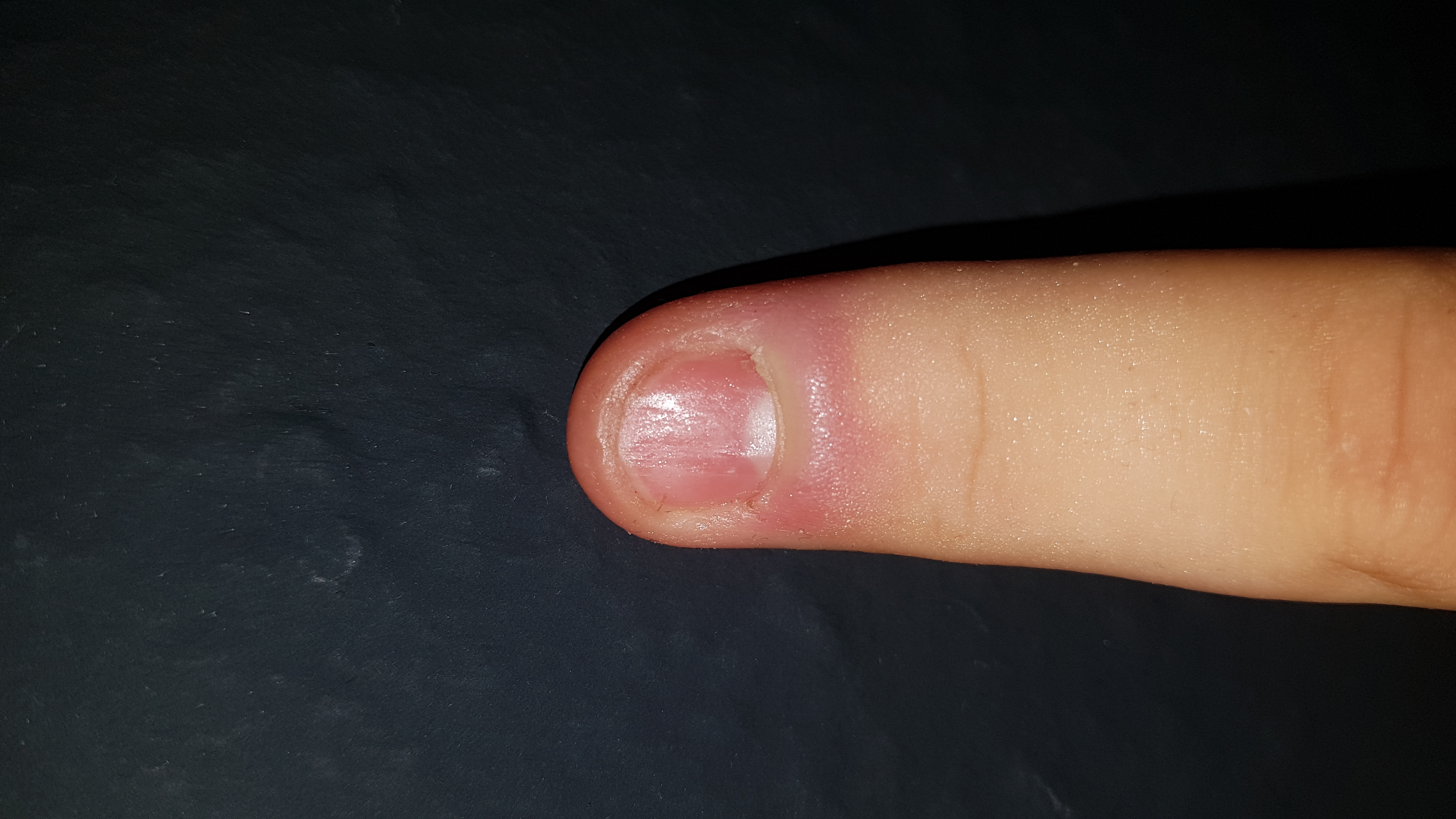 47+ Entzuendung am finger bilder , Entzündung am Finger / Auch ohne Arzt einen Weg? (Schmerzen)