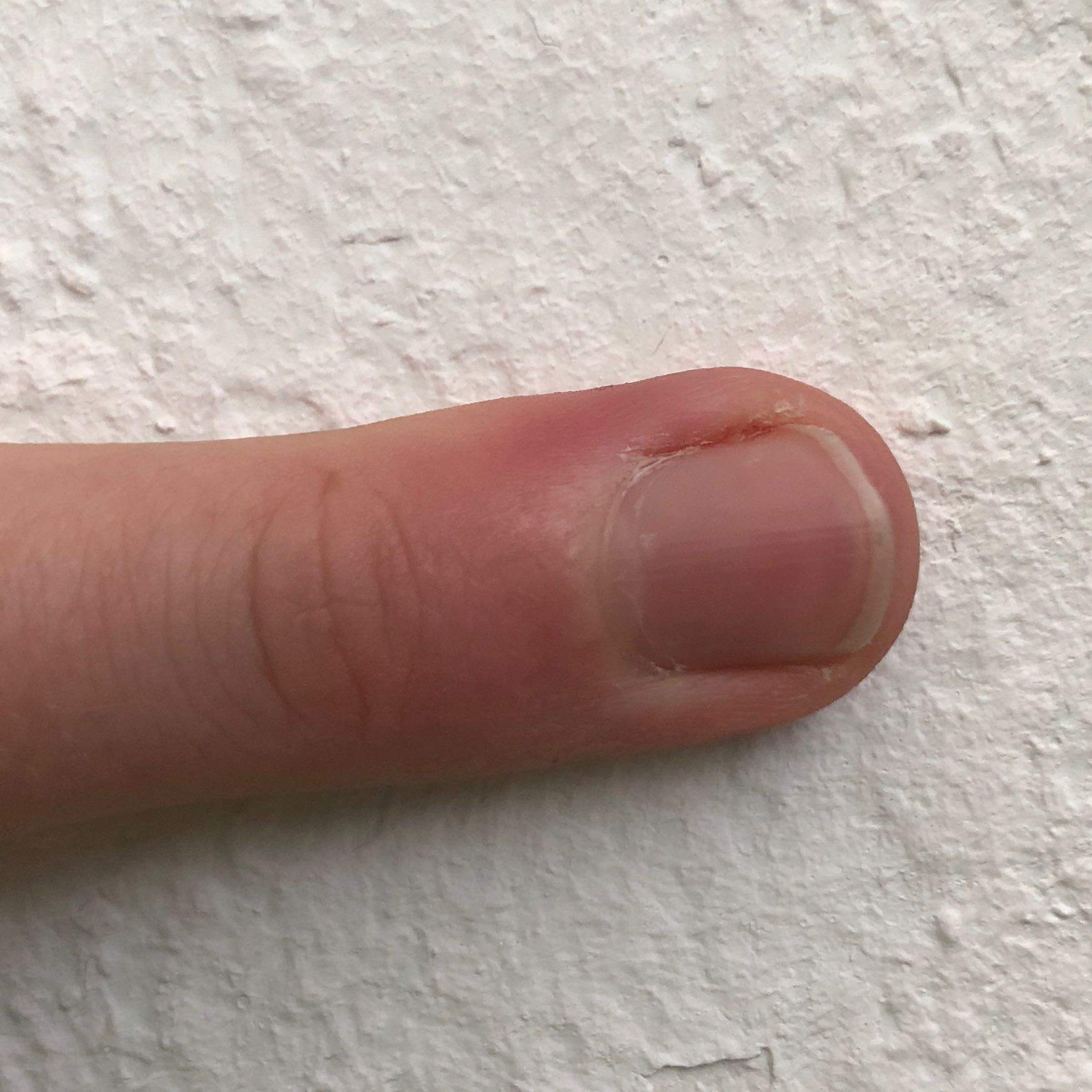 Entzündung am Fingernagelrand? (Gesundheit und Medizin, Medizin, Finger)