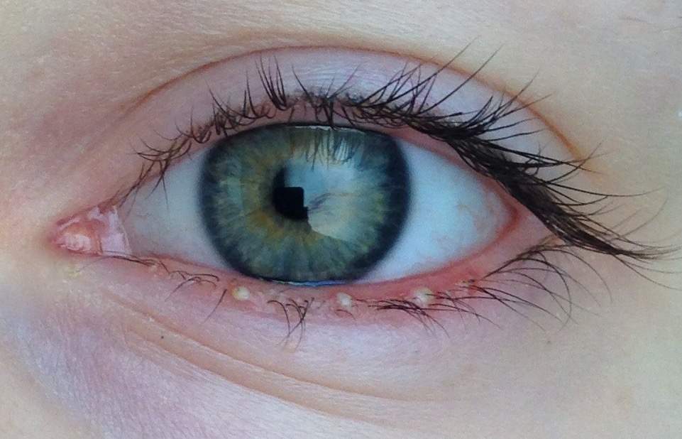 Entzundung Am Unteren Augenlid Geht Einfach Nicht Weg Augen Angeschwollen Gerstenkorn Entzundung Am Unteren Augenlid Geht Einfach Nicht Weg Augen Angeschwollen Gerstenkorn