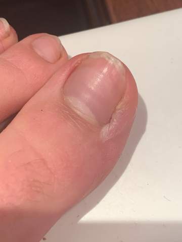 Entzundung Am Zeh Seit 2 Wochen Was Tun Gesundheit Und Medizin Entzundung Am Zeh Seit 2 Wochen Was Tun Gesundheit Und Medizin