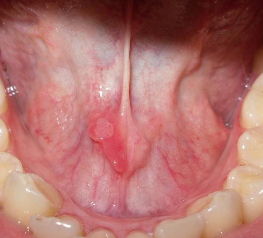 Zungenband - (Gesundheit, Zähne)