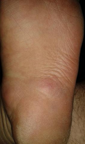 Fußsohle - (Schmerzen, Füße)
