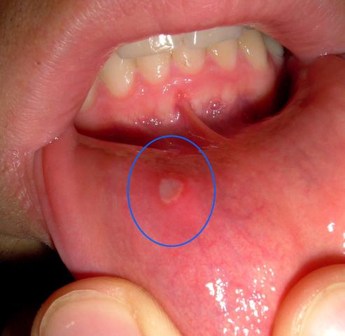 Unterlippen Entzündung - (Lippe, Mund)