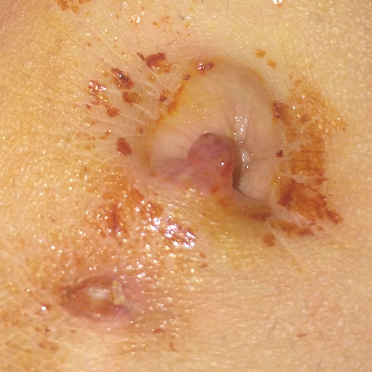 Wie Sieht Ein Entzündetes Bauchnabelpiercing Aus