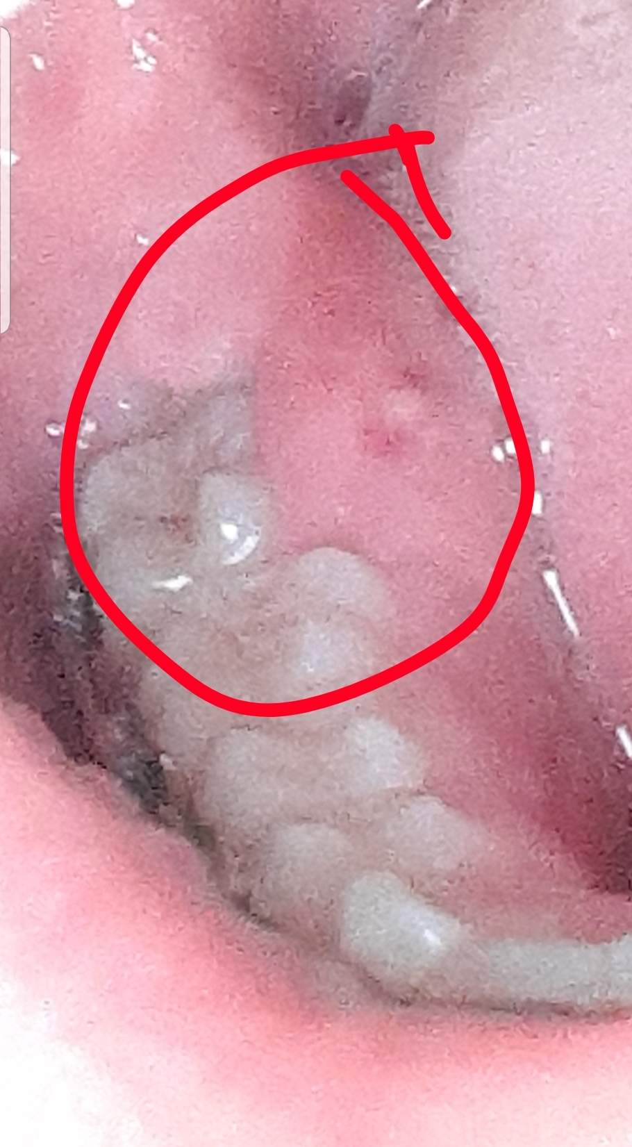 Entzündung bei Weisheitszähnen? (Weisheitszähne)