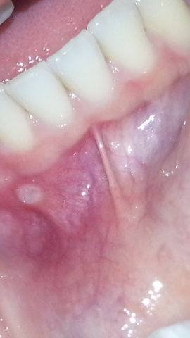  Zahnfleisch - (Gesundheit, Zähne, Entzündung)