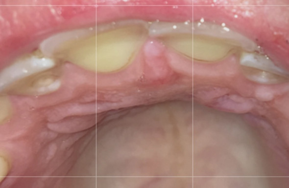 Entzundung Im Mund Am Gaumen Gesundheit Und Medizin Arzt Zahne Entzundung Im Mund Am Gaumen Gesundheit Und Medizin Arzt Zahne