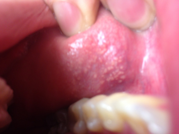 kleine weisse punkte Wangen Innenseite - (Entzündung, Mund, Ausschlag)