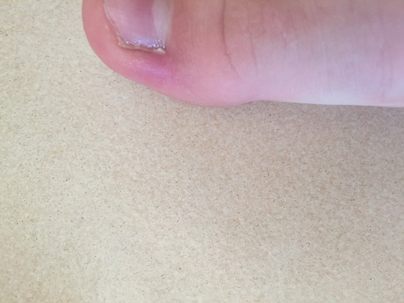 Entzündung im Zeh, Blutvergiftung? (Gesundheit und Medizin, Medizin, Arzt) Entzündung im Zeh, Blutvergiftung? (Gesundheit und Medizin, Medizin, Arzt)