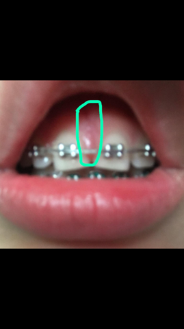 Entzundung Mit Einer Zahnspange Zahnarzt