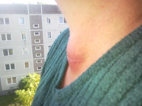 Entzundung Nach Schilddrusenop Operation Schilddruse Entzundung Nach Schilddrusenop Operation Schilddruse
