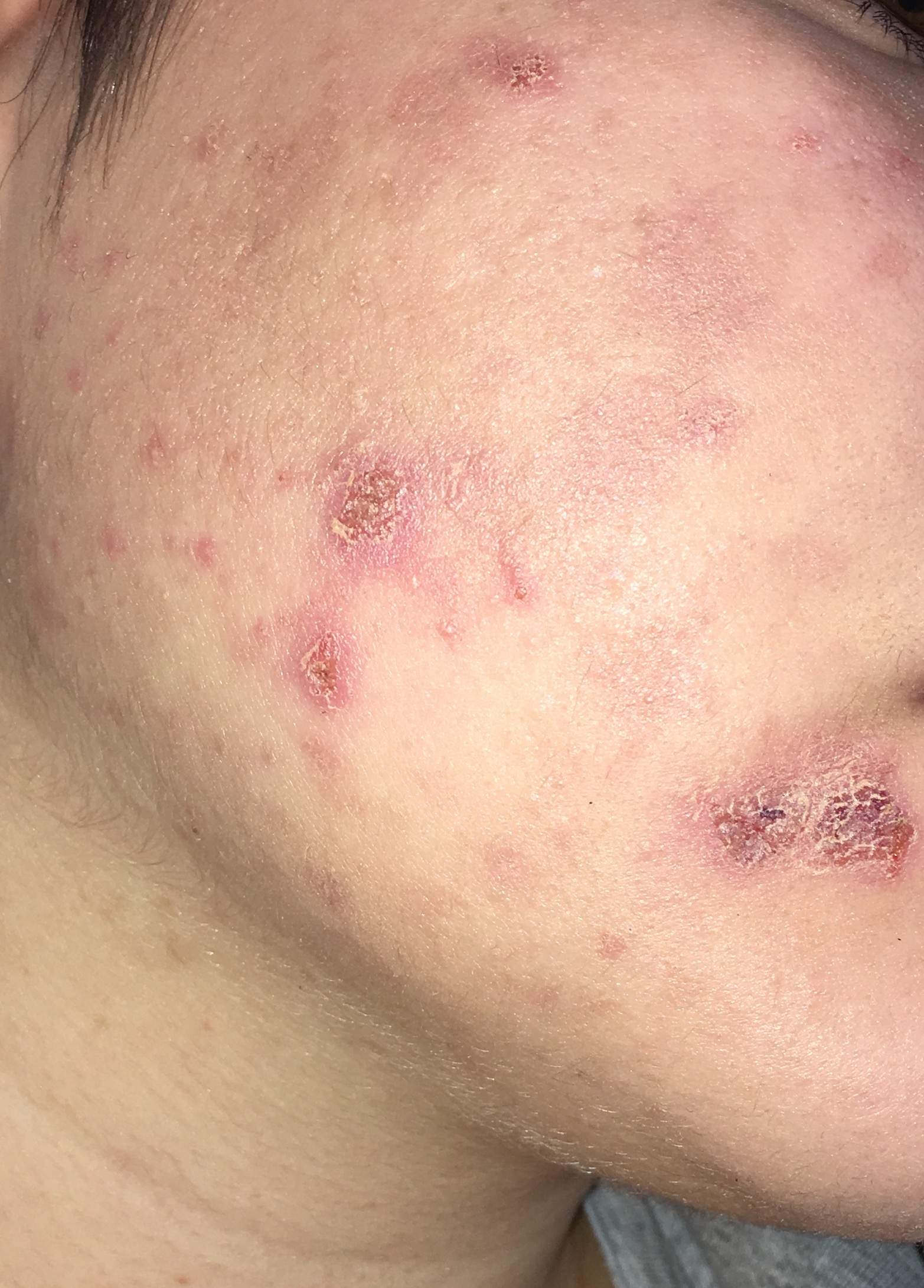 Entzündung Pickel weg bekommen ? (unrein) pickel entzündung