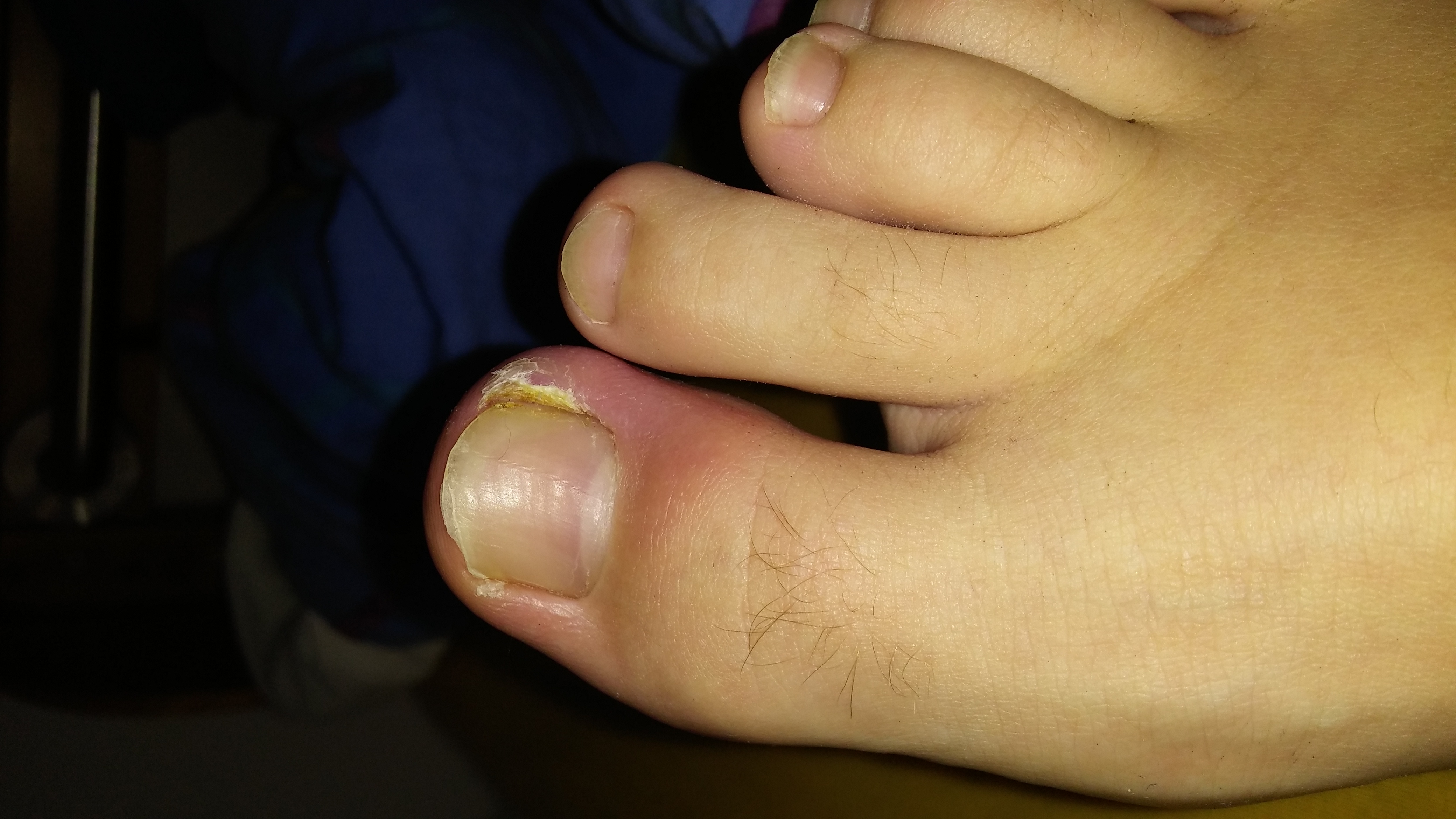 Entzündung Rechter Zeh. Schlimm? (Arzt) Entzündung Rechter Zeh. Schlimm? (Arzt)