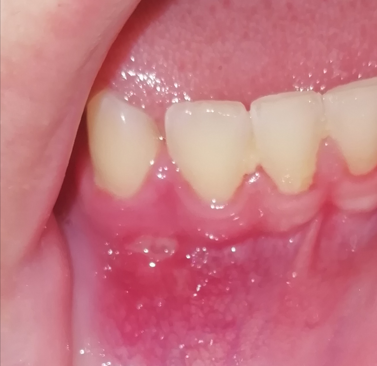 Entzündung/Pickel/sonst was im Zahnfleisch? (Gesundheit und Medizin) pickel entzündung