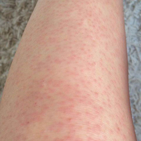 Epilieren Rote Punkte Schmerzen Rote Punkte