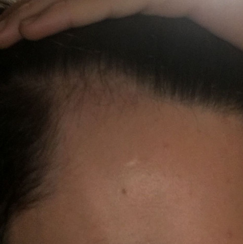 Erblich Bedingter Haarausfall Geheimratsecke Oder Normaler Haaransatz Gesundheit Und Medizin Haare Beauty